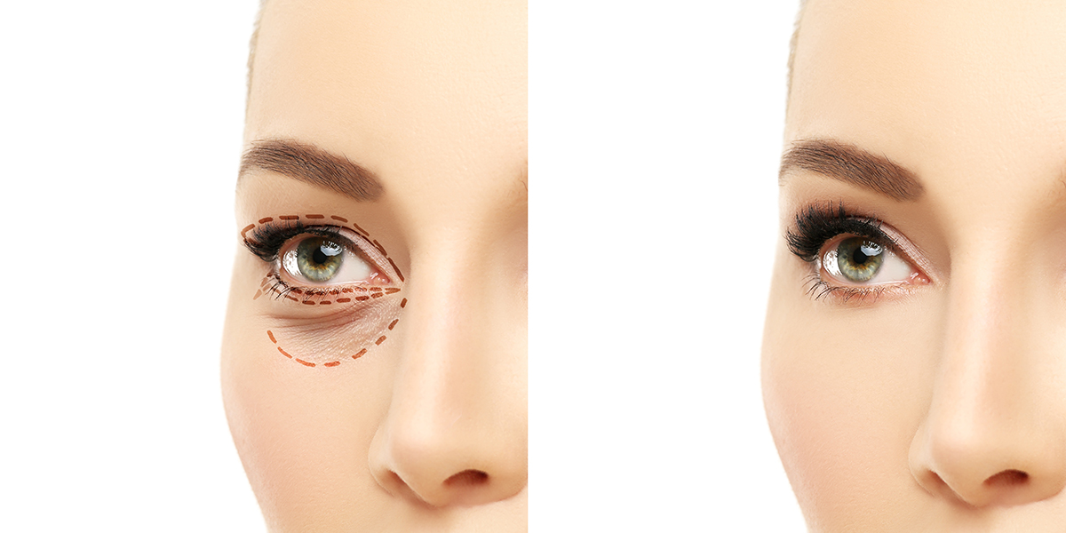 Lower,And,Upper,Blepharoplasty.marking,The,Face.perforation,Lines,On,Females,Face,