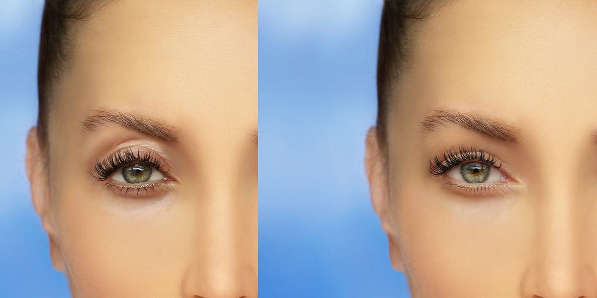 Lower,Eyelid,Blepharoplasty.upper,Blepharoplasty.before,And,After,Cosmetic,Procedures